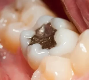 tooth filling