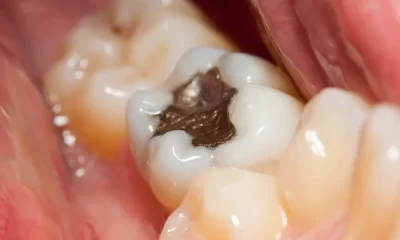 tooth filling