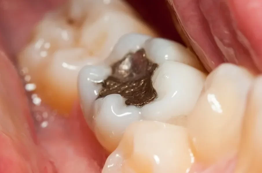 tooth filling