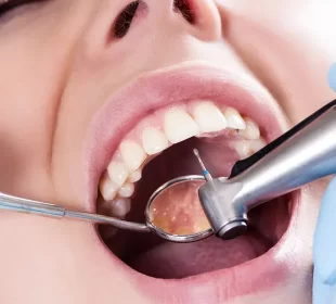 Composite Fillings