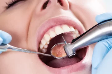 Composite Fillings