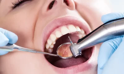 Composite Fillings