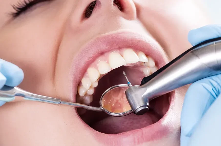 Composite Fillings