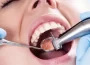 Composite Fillings