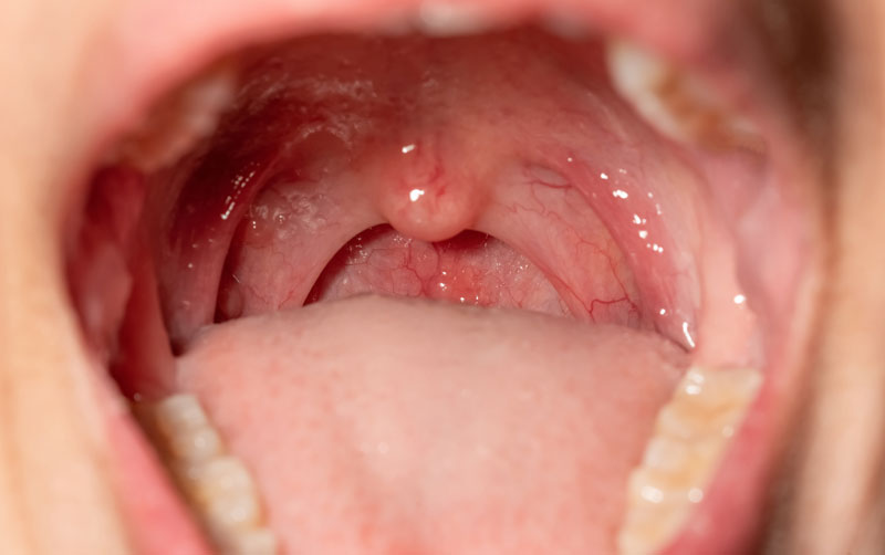 Oral Soft Tissue