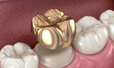 porcelain crowns