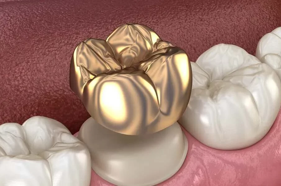 porcelain crowns