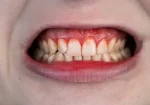 Bleeding Gums