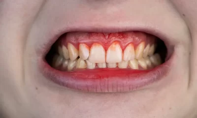 Bleeding Gums