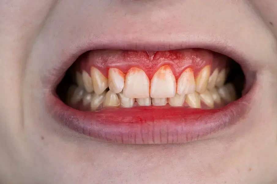 Bleeding Gums