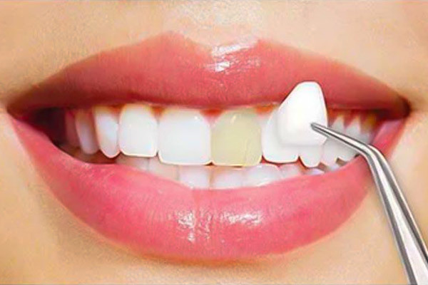 porcelain veneers