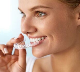 Clear Aligners