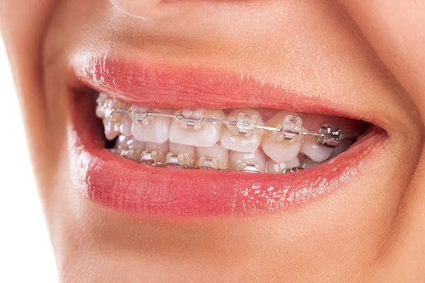 Modern Orthodontic Options